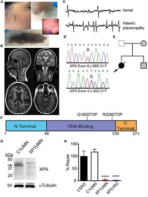 Case Report: Identification of a Heterozygous XPA c.553C>T Mutation Causing Neurological Impairment in a Case of Xeroderma Pigmentosum Complementation Group A